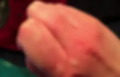 Ajaibnya Bawang, Bisa Jadi Obat Penyembuh Biduran Selain Dua Bahan Alami Ini