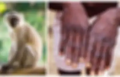 Singapura Siaga Monkeypox, Virus Mematikan yang Mirip Cacar, Belum Ada Vaksin Khusus untuk Mengobatinya