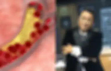 Hotman Paris Hutapea Pernah Didiagnosa Penyempitan Pembuluh Darah: Ini Gejala, Faktor Risiko dan Pencegahannya