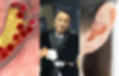 Pernah Bikin Hotman Paris Buru-buru Bagikan Warisan, Ini 4 Tanda Pembuluh Darah Tersumbat, Termasuk Lipatan Telinga