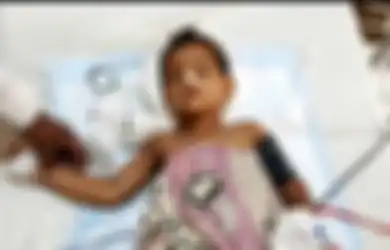 Seperti Keajaiban, Bocah 3 Tahun Ini Bertahan Hidup Setelah Tubuhnya Tertusuk Tongkat Besi dan Jatuh dari Ketinggian 9 Meter