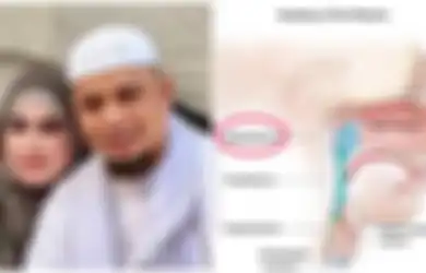 Jangan Sepelekan Mimisan, Bisa Jadi Itu Tanda Kanker Nasofaring Seperti yang Diidap Ustad Arifin Ilham