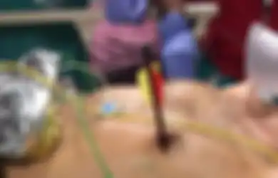 Dengan Panah Tertancap di Dada Pria Ini Bisa Hidup Kembali Setelah Dokter Melakukan Operasi