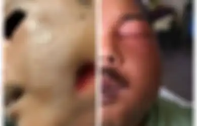 Ingin Obati Sakit Gigi dengan Minyak Rem, Pipi Pria Ini Jadi Bolong