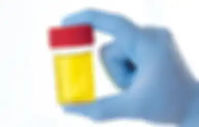 Penelitian: Tes Urin Dapat Bantu Diagnosis Kanker Prostat yang Agresif
