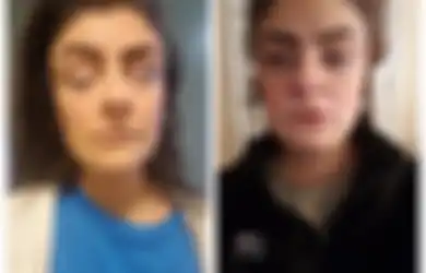 Usai Pilek Wanita Ini Tak Bisa Berkedip dan Mengunyah Selama 5 Minggu, Ternyata Alami Lumpuh Wajah
