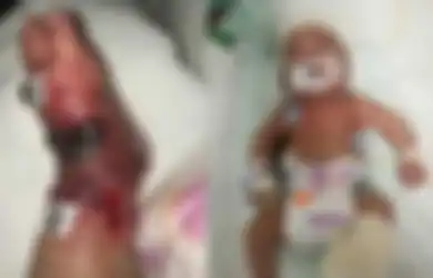 'Salah Tusuk' Saat Transfusi Darah, Kaki Seorang Bayi Jadi Bengkak, Doketr dan Perawat Saling Menyalahkan