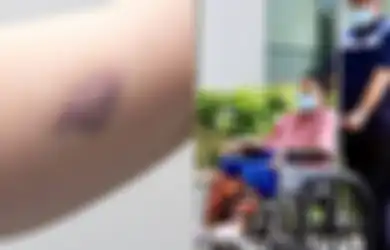 Ani Yudhoyono Meninggal Dunia, Inilah 16 Gejala Leukemia yang sering Dianggap Remeh Orang