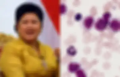 Ani Yudhoyono Meninggal Dunia: Ternyata Sel Leukemia Bisa 'Diatur' Agar Hancurkan Dirinya Sendiri, Ini Caranya!