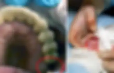 Hilang dari Rahang, Ternyata Gigi Geraham Seorang Bocah 13 Tahun Tumbuh di Dalam Alat Vitalnya