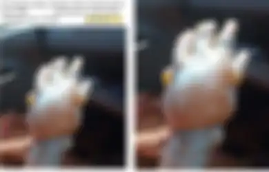 Tangan Pria Ini Jadi Bengkak Mengerikan Setelah Luka Bakar Dioles Pasta Gigi, Ini Cara yang Tepat untuk Atasi Luka Bakar