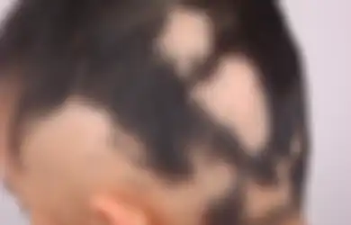 Menyisir Rambut Anak dan Temukan Kebotakan? Kenali Kelainan Alopesia Areata