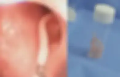 Sakit Perut Selama 10 Tahun Gara-gara Cacing Raksasa, Penyebabnya Ternyata Sering Dianggap Sepele