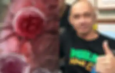 Agung Herkules Idap Kanker Otak: Jangan Sepelekan Sakit Kepala Berulang di Bagian yang Sama, Bisa Jadi Gejala Kanker Otak
