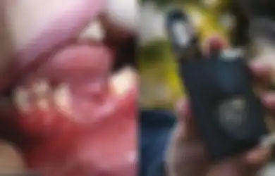 Rokok Elektronik yang Digunakan Remaja Ini Meledak pada Mulutnya hingga Membuat Gigi Rontok dan Rahang Rusak