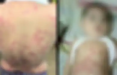 Bayi Ini Tertular Alergi Kulit Lewat ASI Karena Produk Pemutih Palsu yang Dipakai Ibunya, Peringatan Bagi Orangtua!