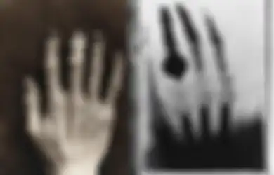 Foto Mengerikan Percobaan Fatal Sinar-X Hingga Merusak Kulit, Wajah, dan Merontokkan Rambut