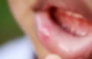 Waspadai Bercak Putih atau Kemerahan di Bibir, Bisa Jadi Tanda Kanker Mulut!