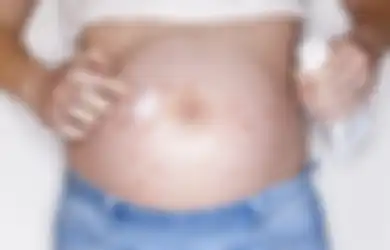 Alami Biduran Saat Hamil? Ini yang Bisa Anda Lakukan, dari Mandi Air Dingin Hingga Hindari Stres