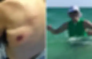 Kurang dari 48 Jam Setelah Berenang di Pantai, Pria Ini Terinfeksi Bakteri Pemakan Daging dan Meninggal
