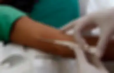3 Bulan Mengalami Pendarahan, Ternyata KB Implan Wanita Ini Geser ke Paru-paru dan Harus Dioperasi