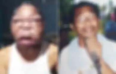 Wajahnya Membengkak Jadi 'Raksasa', Pria Ini Alami Penyakit Mistrius, Begini Gejalanya