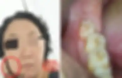 Wanita Meninggal 5 Hari Usai Cabut Gigi Bungsu, Keluarganya Tak Terima Dokter Sebut Penyebab Kematiannya Karena Tumor