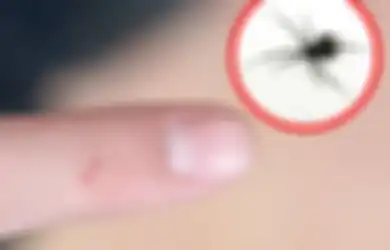 Pernah Digigit Laba-laba, Kutu, Hingga Lebah? Jangan Panik, Begini Cara Mengobatinya