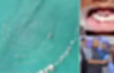 Sering Sakit Gigi dan Bengkak, Ternyata Bocah Ini Punya Ratusan Gigi di Mulutnya, Lihat Videonya!