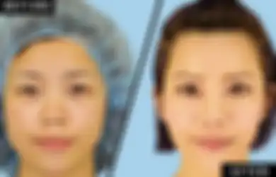 Inilah 6 Operasi Plastik Paling Sering Dilakukan di Korea Selatan, Benarkah Bikin Jadi Lebih Cantik?