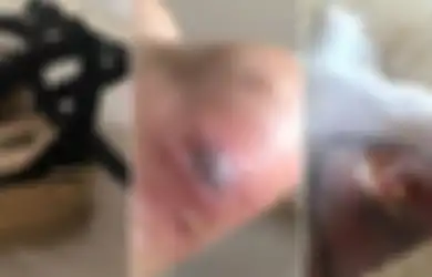 Wanita Ini Nyaris Meninggal Akibat Infeksi yang Disebabkan Sepatu dengan Model Seperti Ini