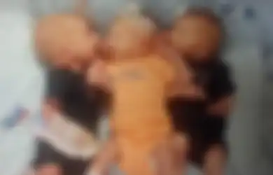 Awalnya Dikira Batu Ginjal, Wanita Ini Ternyata Harus Jalani Operasi Dadakan untuk Lahirkan Bayi Kembar Tiga