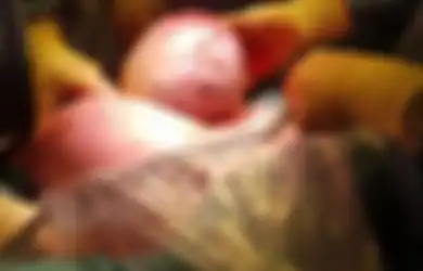 Seorang Ibu Terkejut Ketika Melahirkan Bayinya Seperti 'Alien', Namun Setelah Tumbuh Dewasa Beginilah Kondisinya