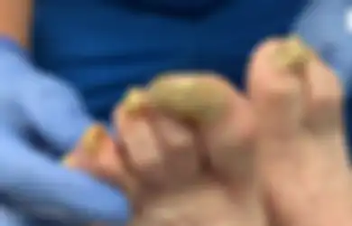 Setahun Tak Potong Kuku, Kaki Wanita Ini Digerogoti Jamur Hingga Hal Mengerikan Ini Terjadi Pada Kakinya