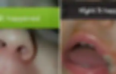 Mulut Anak Ini Melepuh Karena Charger Ponsel, Peringatan Buat Orangtua Agar Tidak Sembarangan Menaruhnya
