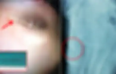 Tak Bisa Buang Air Kecil Selama 3 Hari, Rupanya Ada Jarum 9cm Menyumpat Organ Vital Bocah Ini, Kok Bisa?