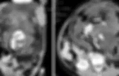 Bukan Seorang Kanibal, Dokter Temukan Massa Tulang Hingga Rambut Manusia di Perut Gadis 17 Tahun, Ternyata Hal Ini yang Dialaminya