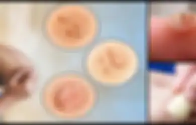 Bawang Putih: Obat Alami yang Paling Efektif Untuk Atasi Kutil dan Mata Ikan, Simak Cara Terbaik Menggunakannya!