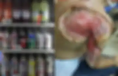 Tangan Pria Ini Melepuh dan Hampir Hancur, Hati-hati! Penyebabnya Minuman yang Sering Kita Konsumsi Ini