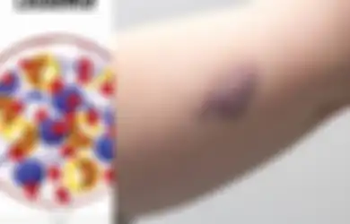Sering Kita Abaikan, Ini 5 Gejala Leukemia, Salah Satunya Memar