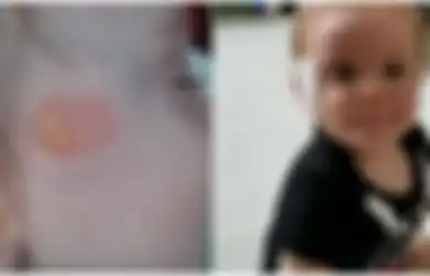 Bayi Tujuh Bulan Alami Luka Bakar Mengerikan Ketika Bangun Tidur, Penyebabnya Benda Lembut yang Justru Biasa Orang Tua Berikan, Peringatan Buat Para Orangtua!