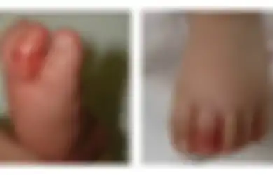 Peringatan Buat Orangtua! Bayi Ini Hampir Kehilangan Jari Kakinya Hanya Gara-gara Ini