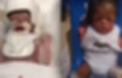 Perjuangan Hidup Bayi Ja'bari, Lahir Tanpa Kulit dengan Berat 1,12 kg hingga Berhasil Tertutup Kulit Sepenuhnya dan Beratnya Jadi 6,7 kg