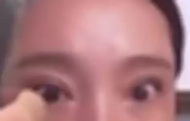 Mata wanita tersebut sebelum operasi
