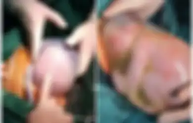 Bayi Laki-laki Ini Dilahirkan dalam Keadaan Masih Terbungkus Kantung Ketuban, Diangkat dengan 'Damai' dari Perut Ibunya