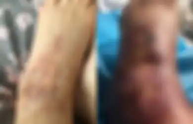 Wanita 41 Tahun Ini Nyaris Kehilangan Kakinya Setelah Alami Infeksi Membusuk Saat Berada di Tepi Kolam Renang Karena Hal Ini