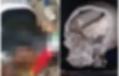 Seorang Demonstran Ditemukan Tewas dengan Tabung Gas Air Mata Bersarang di Dalam Otaknya