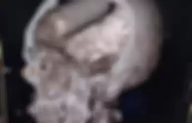 Hasil x-ray menunjukkan tabung gas air mata bersarang di otak seorang demonstran