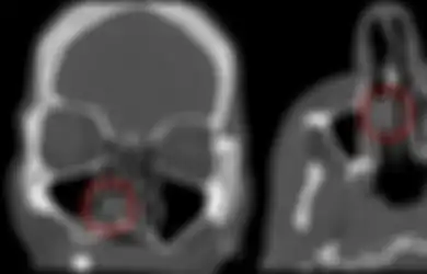 Sering Pusing Mendadak, Dokter Terkejut Ada Ganja Tersangkut di Dalam Hidung Pria Ini Selama 18 Tahun, Kok Bisa?