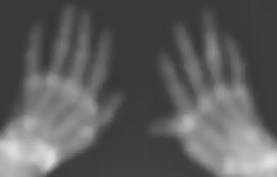 Alami Nyeri Sendi Kronis Selama 40 Tahun, Saat Lakukan X-Ray Ditemukan Serpihan Emas di Dalam Sendi Wanita Ini, Kok Bisa?